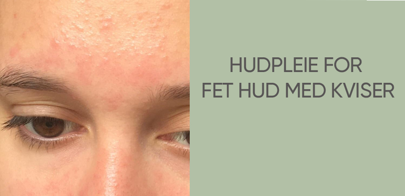 Hudpleie for fet hud med kviser