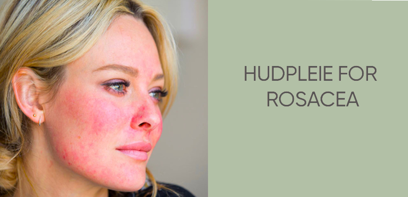 Hudpleie for roscea