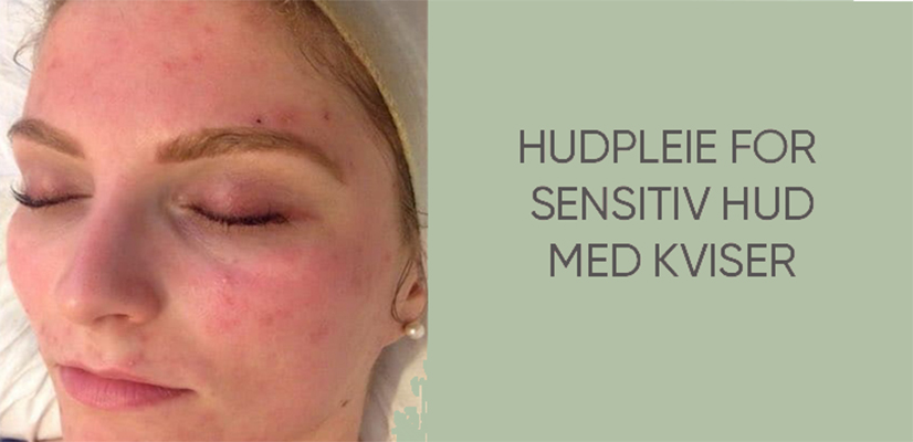 Sensitiv hud med kviser