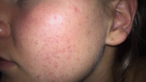 Kaja 3 uker etter at hun begynte å bruke Mario Badescu