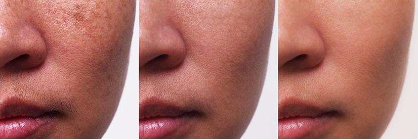 Slik blir du kvitt pigmenter og arr