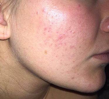 Kaja 3 uker etter at hun begynte å bruke Mario Badescu