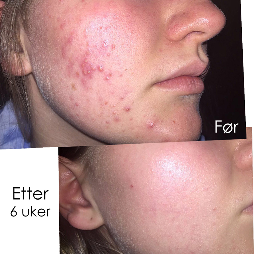 kaja før og etter behandling