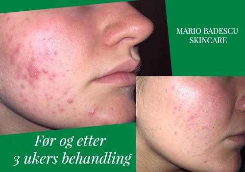 Kaja før og etter kvisebehandling på Karma.no