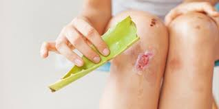 Aloe vera er betennelsesdempende for huden