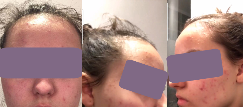 Før bilde - før behandling for kviser