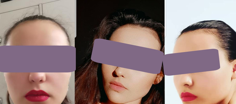 Etter kvisebehandling karma.no