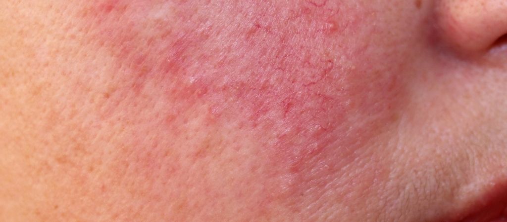 Hudpleie : serum og oljer for rosacea