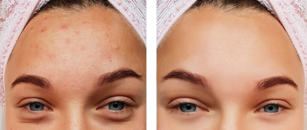 serum for kviser og uren hud