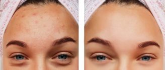 serum for kviser og uren hud