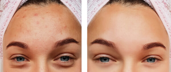 serum for kviser og uren hud