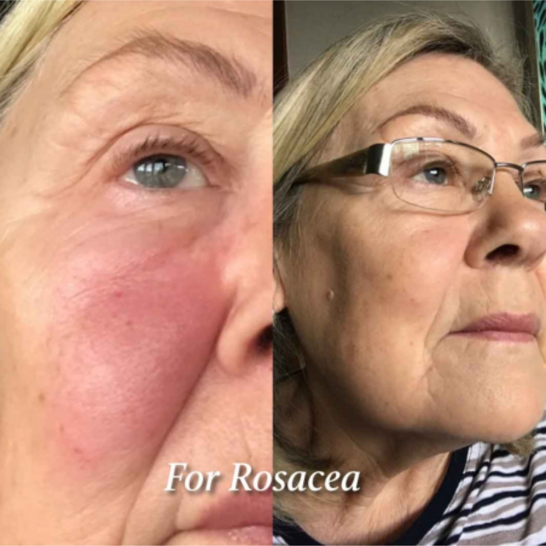 ROSACEA CLEAN SKIN SYSTEM ECO BY SONYA