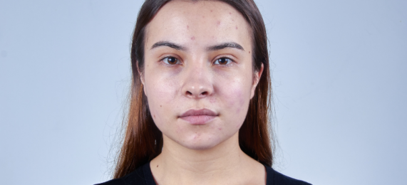 Hudpleietips for fet hud med kviser