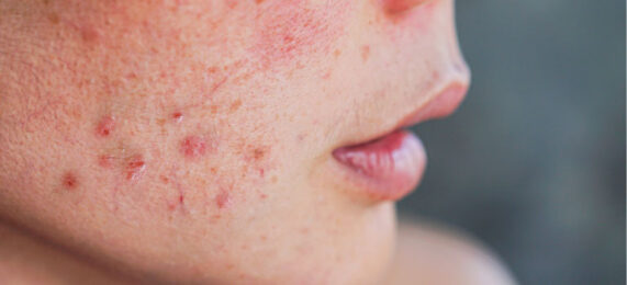 Hudpleie for sensitiv hud med kviser