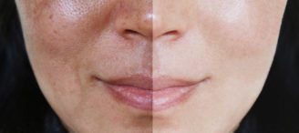 Vitamin C mot pigmentflekker