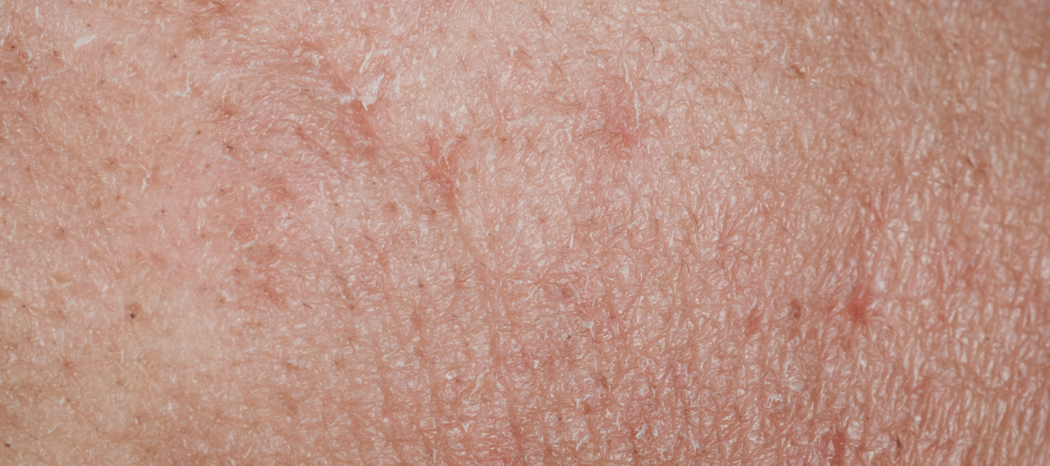 Slik pleier du tørr hud og dehydrert hud