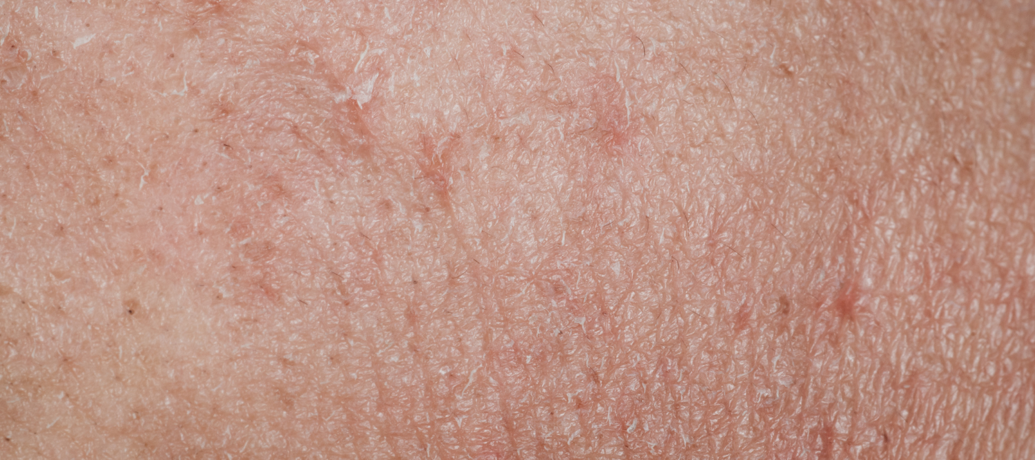 Slik pleier du tørr hud og dehydrert hud