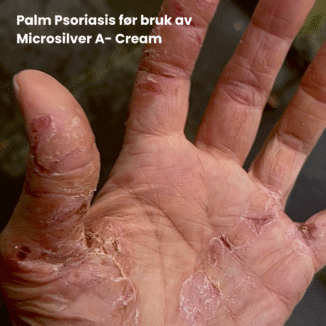 Wooden Spoon Microsilver A Cream for atopisk eksem. effektiv behandling