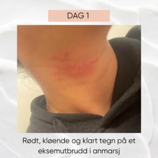 wooden spoon microsilver a cream for atopisk eksem