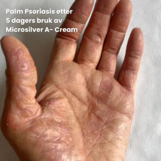 Wooden Spoon Microsilver A Cream for atopisk eksem. effektiv behandling