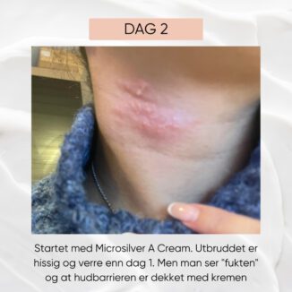 wooden spoon microsilver a cream for atopisk eksem