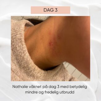 wooden spoon microsilver a cream for atopisk eksem