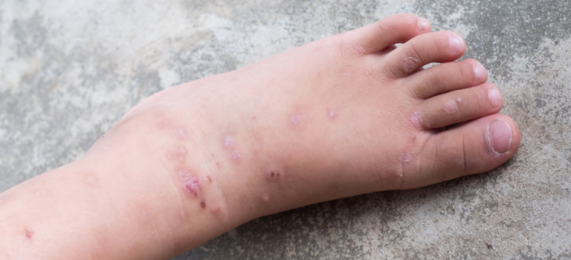 tips for atopisk eksem