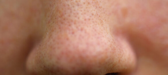 Bli kvitt sorte prikker og store porer