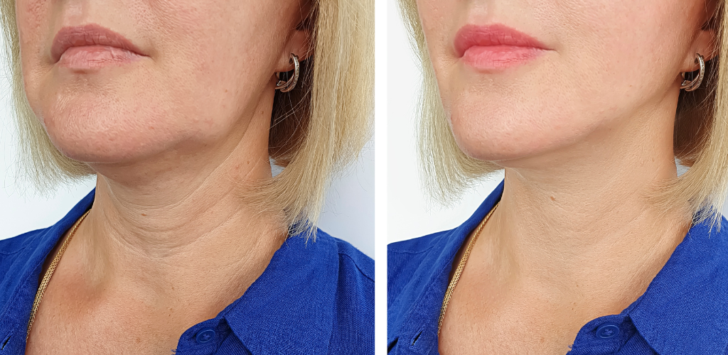 Hvordan stimulere kollagenproduksjonen og stramme opp huden.