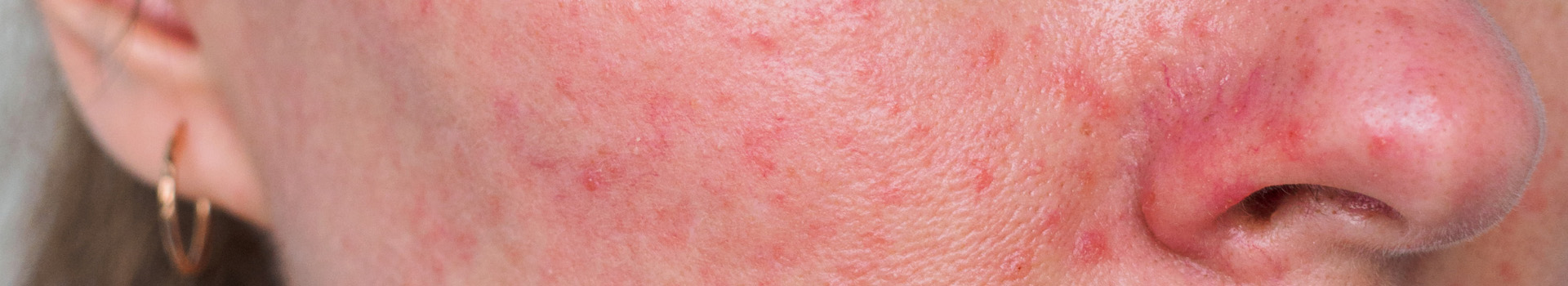 Rosacea og eksem